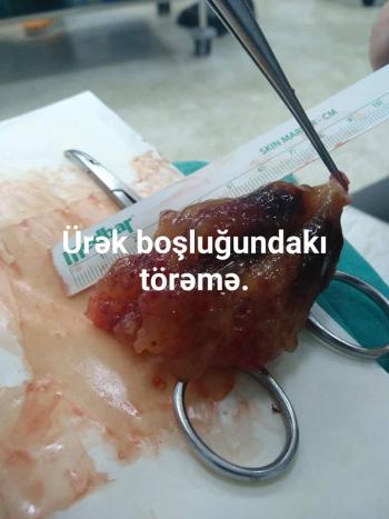 Azərbaycanda 42 yaşlı qadının ürəyindən 8,5 sm-lik törəmə çıxarıldı