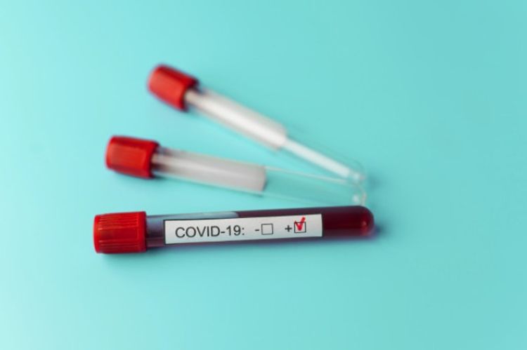 Rusiyada daha 4 nəfər koronavirusdan ölüb