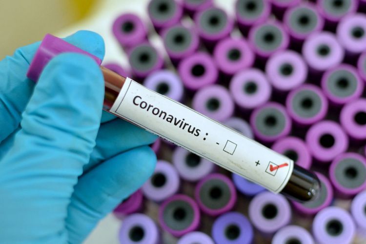 Ermənistanda daha 47 nəfərdə koronavirus aşkarlandı