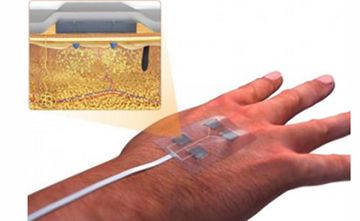  “Ağıllı” sarğı bandajı tez-tez dəyişdirmək ehtiyacını aradan qaldıracaq - YENİLİK