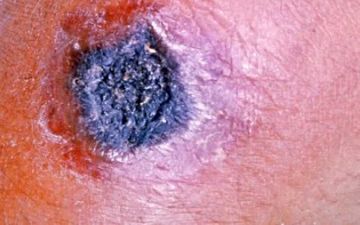  Baş infeksionist təhlükəli xəstəlikdən danışıb - Bunlar BAKTEROLOJİ silahdır