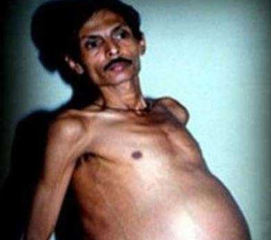 Alimləri heyrətə gətirən OLAY: Əkiz qardaşını 36 il qarnında daşıyıb - FOTO