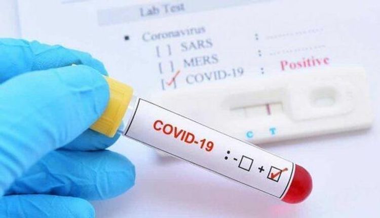 Ermənistanda koronavirusdan daha 35 nəfər öldü