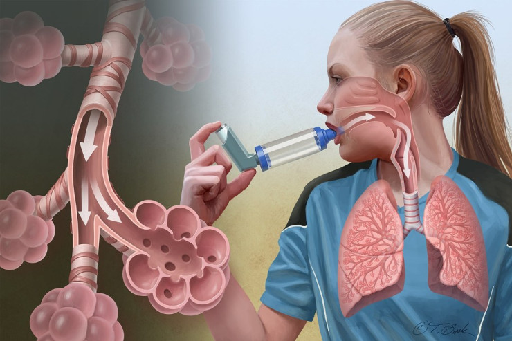 Astma xəstələrinə XƏBƏRDARLIQ:  Bunu etməyin,  TƏHLÜKƏLİDİR 