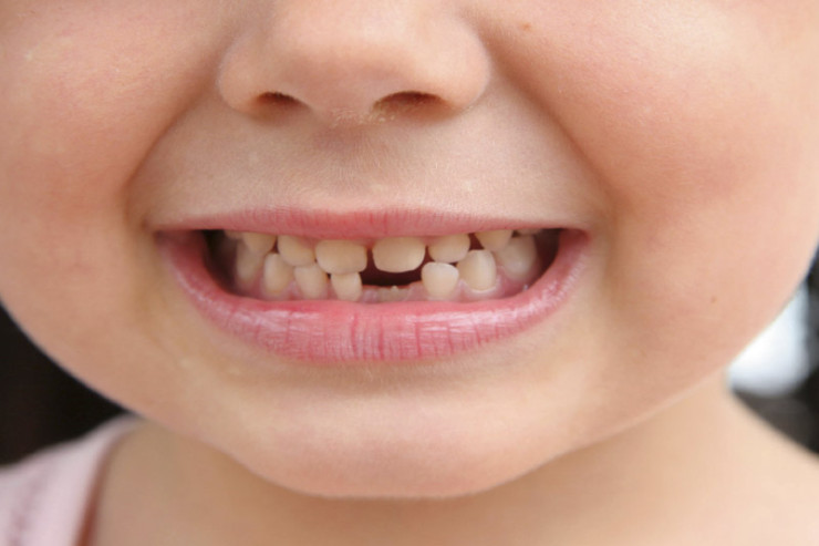 Uşaqların  diş müalicəsi   nə vaxt başlaya bilər?