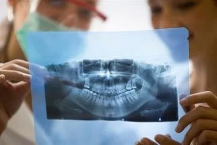 Diş rentgeni barədə bunları mütləq bilməlisiniz 