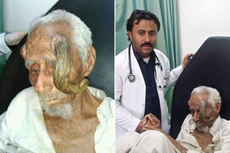 130 yaşlı qoca "buynuz" əməliyyatından sonra  ÖLDÜ 