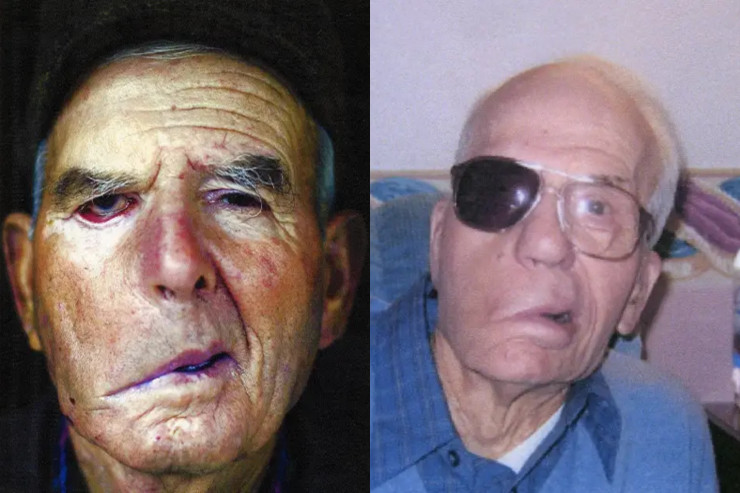 Başında güllə ilə 94 il yaşadı -  Dəhşətli hekayənin   təfərrüatları