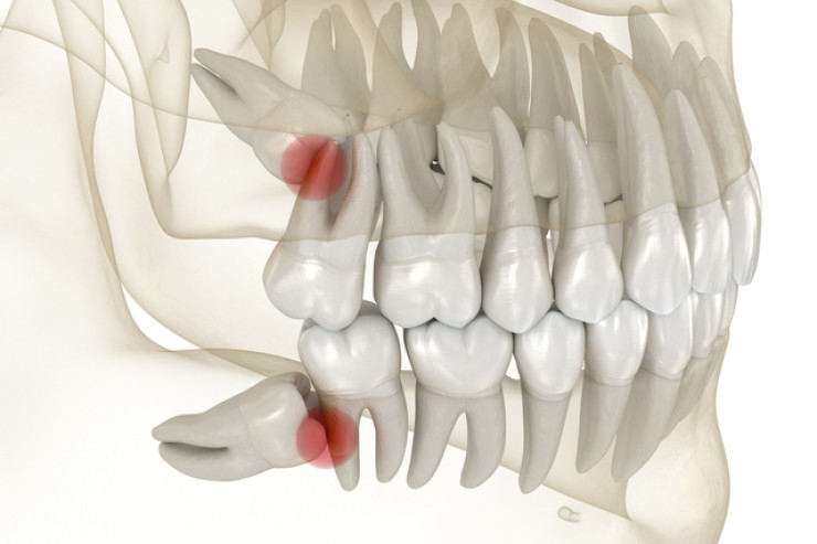 Ağıl dişləri nə üçündür? – Heç düşünmüsünüzmü? 