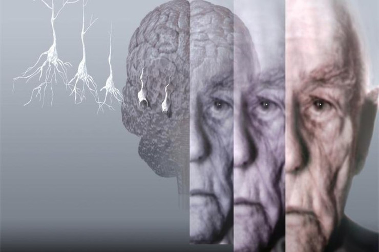  Alzheimer xəstəliyinin   yeni səbəbi TAPILDI