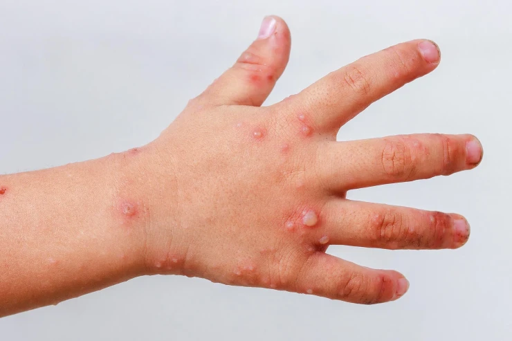 Çimərliklərdən uşaqlara virus yayılır? - Suçiçəyinə  bənzəyir, lakin...