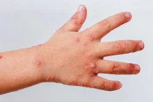 Çimərliklərdən uşaqlara virus yayılır? - Suçiçəyinə  bənzəyir, lakin...