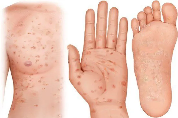 Sifilis geri döndü:  Keçən əsrdən qalma infeksiya niyə yenidən güclənir? 