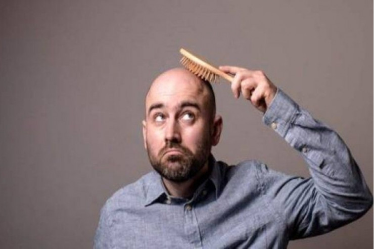 Kişilərdə keçəlləşmə artır – Bəs səbəb nədir? - VİDEO