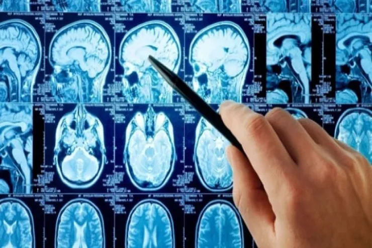 Kasıblar varlılardan daha çox insult  keçirirlər