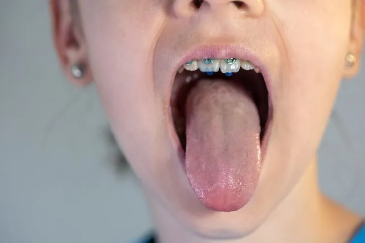 Səhərlər dilin üzərində niyə ağ örtük yaranır? 