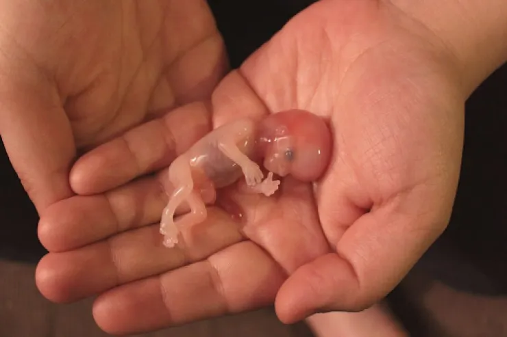 Azərbaycanda abortların  sayı artdı