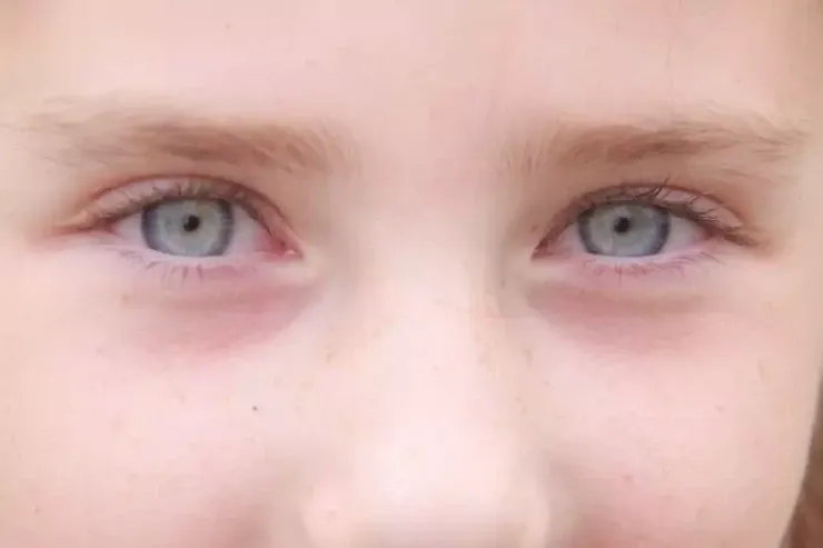 Dünyanın ən uzun kirpikli  qadını - Tökülür, yenidən çıxır