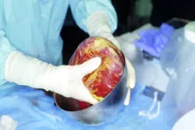 Azərbaycanda meyitdən insana  ürək köçürüldü - İLK