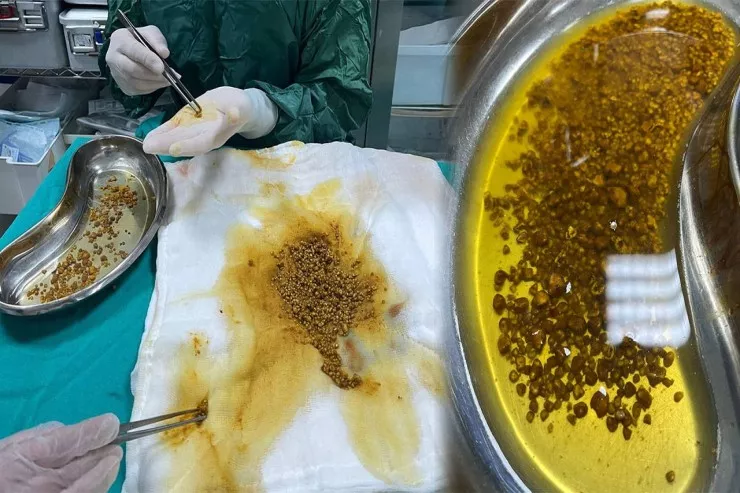 Tibb dünyasını  təəccübləndirən  əməliyyat - Öd kisəsindən 2067 daş  çıxarıldı