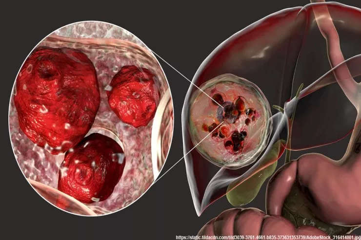 Bakıda 17 yaşlı qızın bədənindən 21 şiş  çıxarıldı - FOTO 