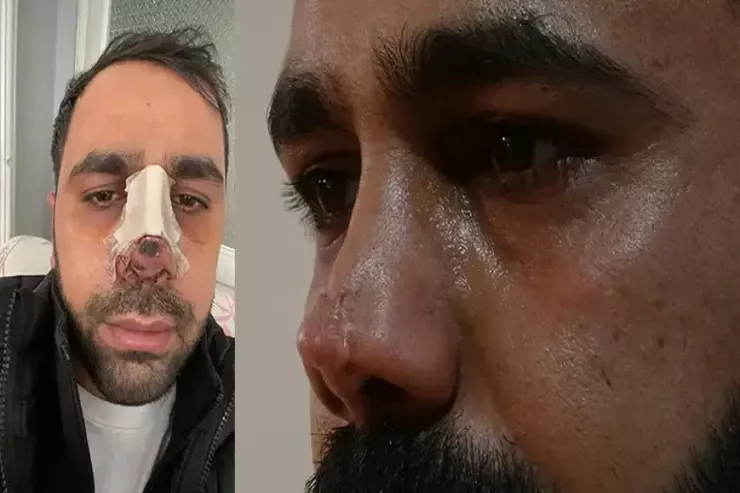 İkinci dəfə estetik əməliyyat olunan kişinin  burnu çürüdü 