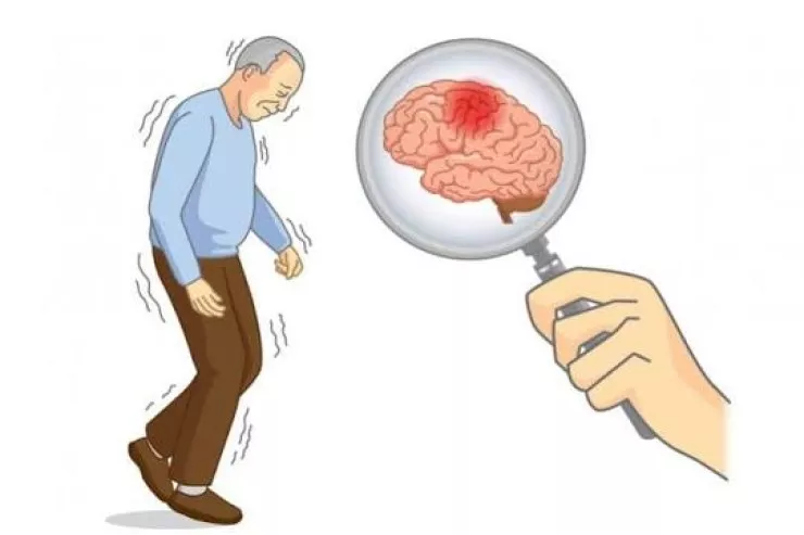 Parkinson xəstəliyi beyində belə yayılırmış 