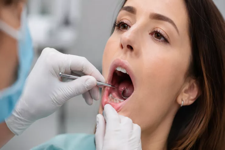 Ağız xərçəngi  çox vaxt nəzərə çarpmayan bir əlamətlə başlayır - nəyə diqqət yetirmək  lazımdır?