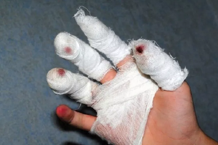 Göygöldə pirotexniki vasitə uşağın əlində partladı, barmağı kəsildi 