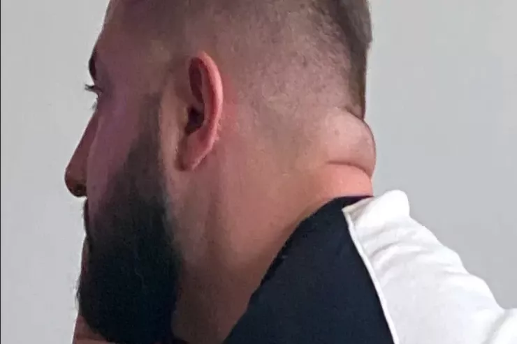 Boynunuzun  qalın olması   insult və diabet XƏBƏRDARLIĞIDIR 